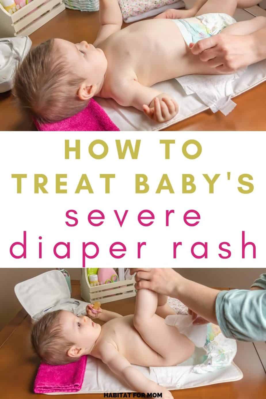 How To Treat Diaper Rash In Babies